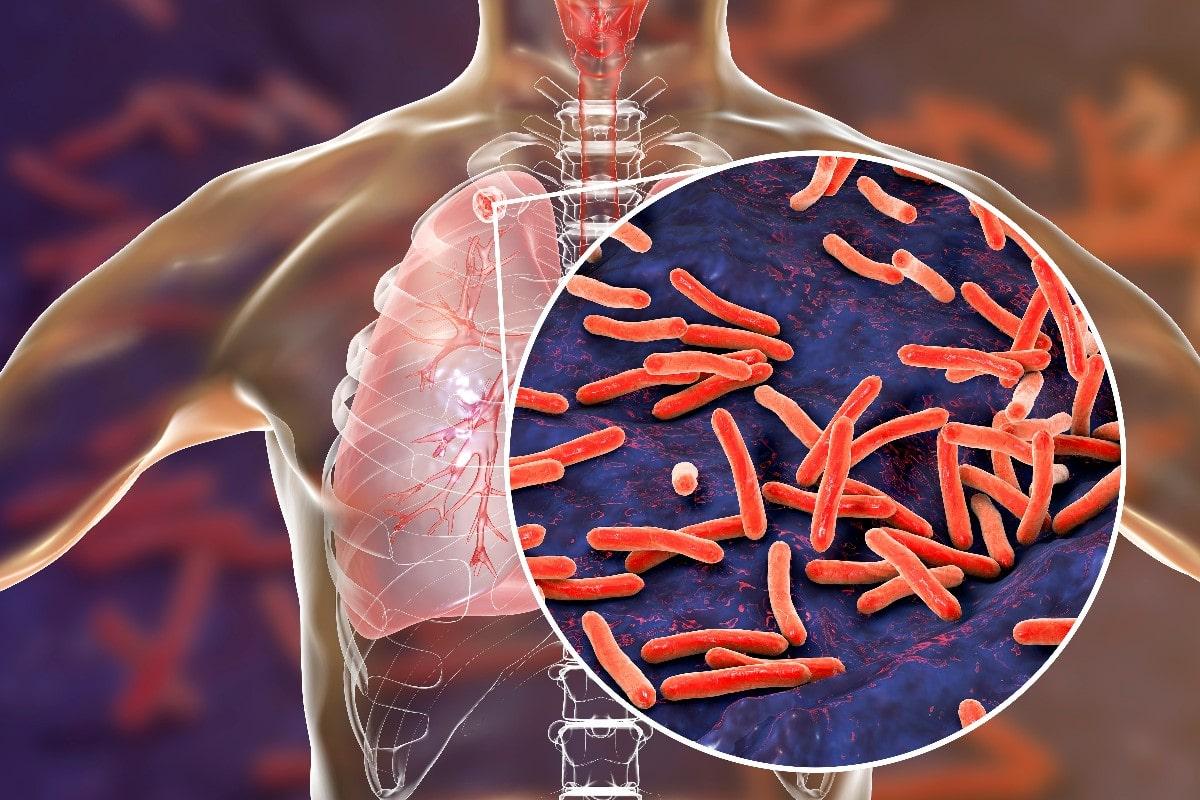 Mycobacterium Tuberculosis Qué Es Características Morfología Cultivo 1299